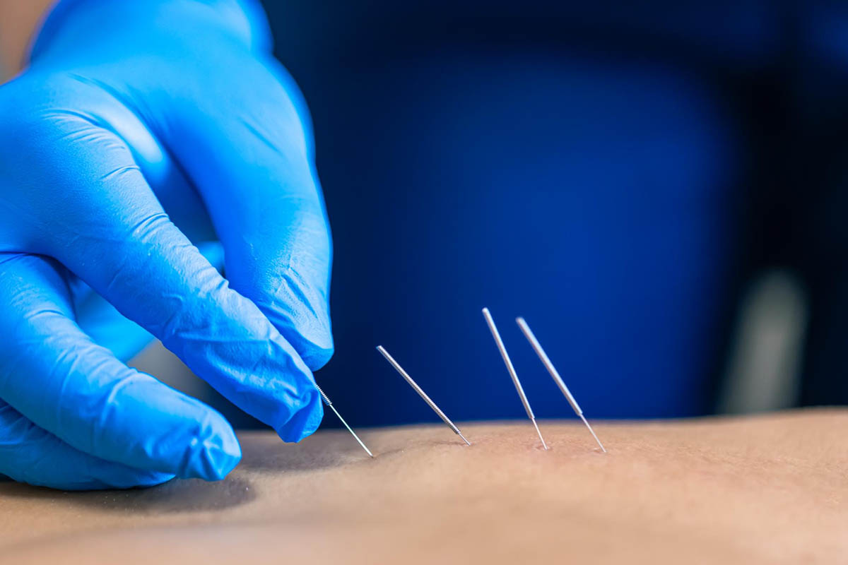 Dry Needling
