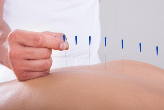 Physiotherapist performing dry needling therapy on a patient's back at Health Plus Physiotherapy Clinic in Marunji, Pune.